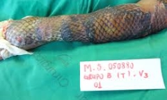 Độc đáo cách chữa bỏng bằng da cá rô phi ở Brazil