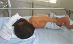 Em bé 8 ngày tuổi phải thay máu hoàn toàn do bị vàng da