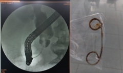 Người đàn ông bỏ quên stent trong đường mật suốt 2 năm