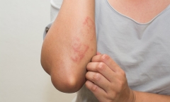 Bệnh viêm da gây bong tróc ngứa ngáy chữa mãi không khỏi: BS gợi ý điều nên làm