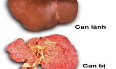 Tránh để rượu bia ngày Tết phá hủy gan, dạ dày