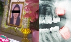 Video: Vừa chiến thắng ung thư, người phụ nữ lại mất mạng vì răng khôn