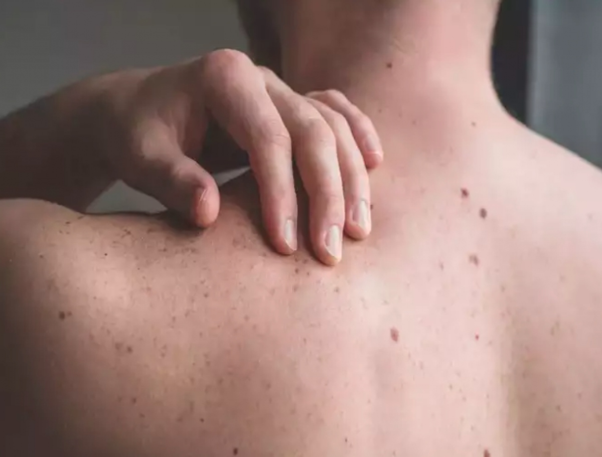 Dấu Hiệu Ung Thư Da Giai Đoạn Đầu