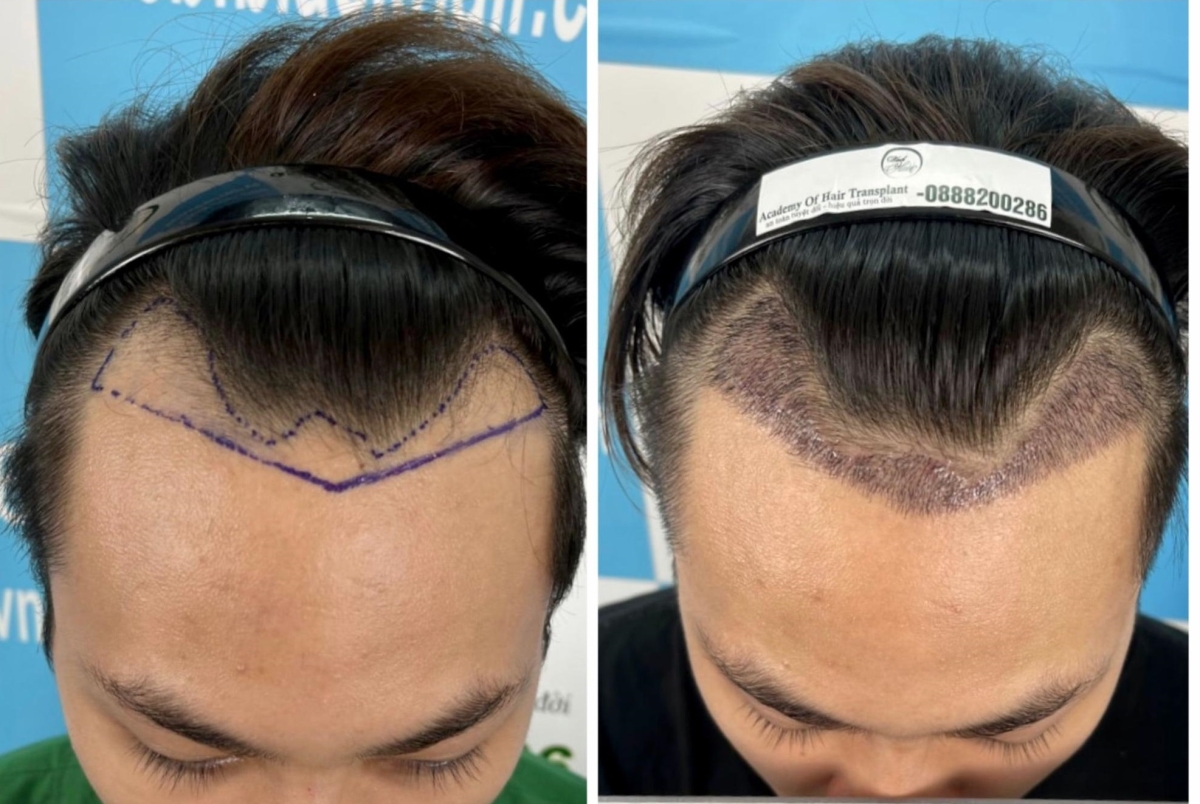 Top 8 Địa chỉ cấy tóc uy tín nhất tại Tp HCM  toplistvn