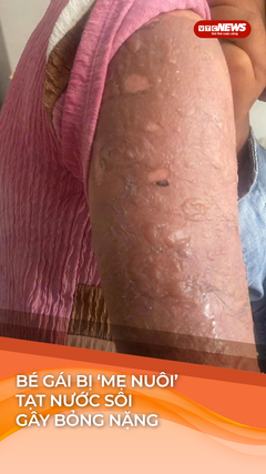 Bé gái bị ‘mẹ nuôi’ tạt nước sôi gây bỏng nặng vì làm mất vé số khi đi bán