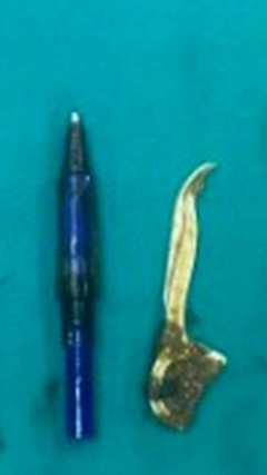 Mắc hội chứng Pica, người đàn ông nuốt bật lửa, bút bi vào bụng