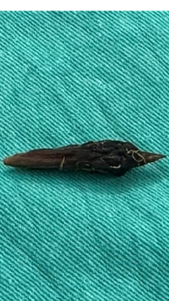 Nhiễm trùng ổ bụng, thủng ruột do nuốt hạt táo đỏ 