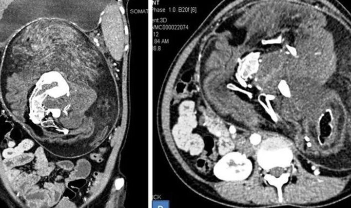 Cô gái mang song thai suốt 17 năm không hề hay biết