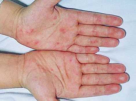 Mồng 1 Tết, một em bé tử vong do bệnh tay chân miệng