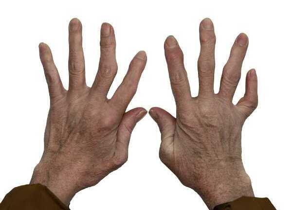 Bài thuốc chữa viêm khớp từ khoai lang và chuối