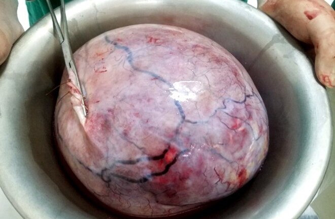 Bệnh viện Yên Bái mổ lấy khối u nặng 5,5kg