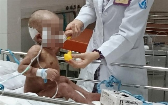 Bé 25 tháng tuổi bị nhiễm độc da, toàn thân bong tróc