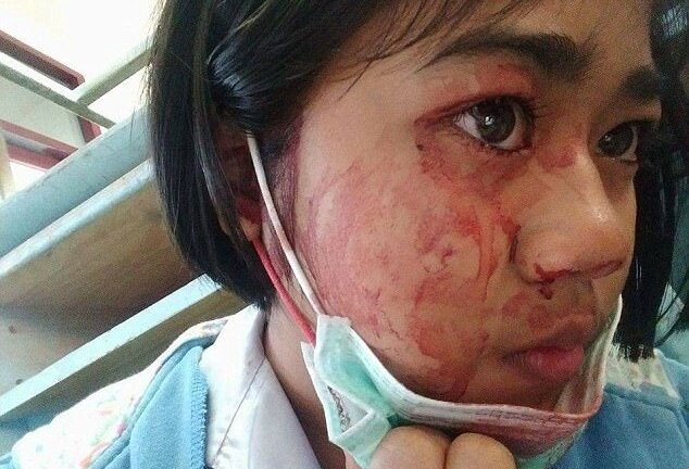 Bé gái 7 tuổi bị chảy máu khắp mặt mỗi khi nhức đầu