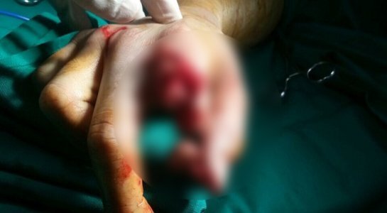 Nối liền ngón tay bị máy xay thịt cắt đứt lìa