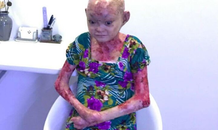 Mắc bệnh lở loét khắp cơ thể, thiếu nữ mang hình hài quái nhân