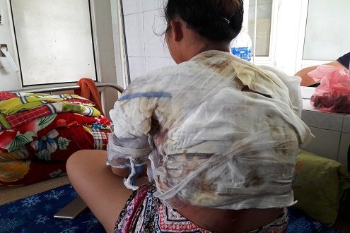 Vợ bị chồng dội cả ấm nước sôi lên người vì... đòi ly hôn