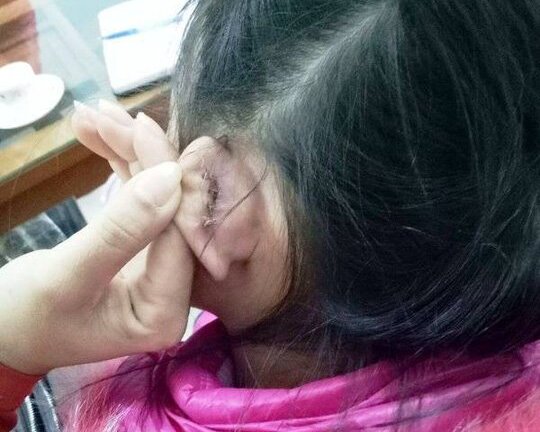 Học sinh bị xách rách tai khâu 4 mũi ở Thanh Hóa, hiệu trưởng nói 'nghe phong thanh'