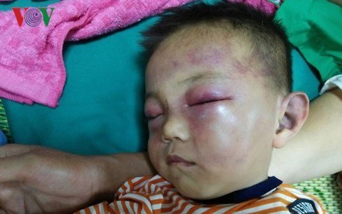 Bé trai 2 tuổi bị đánh đập dã man ở Nghệ An: Vì sao không truy cứu cha dượng?