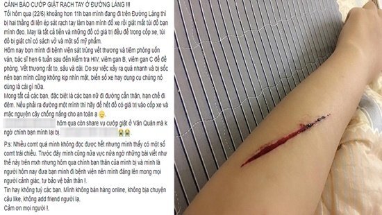 Sự thật thông tin nữ sinh viên bị rạch tay, giật túi xách ở Hà Nội