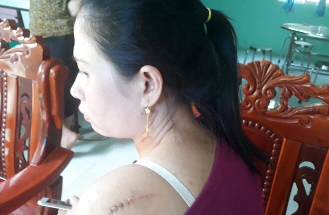 Cô dâu kể phút kinh hoàng bị chồng cũ rượt chém tại tiệc cưới