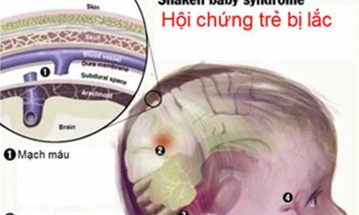 Trẻ dễ động kinh bởi thói quen rung lắc khi bế của người lớn