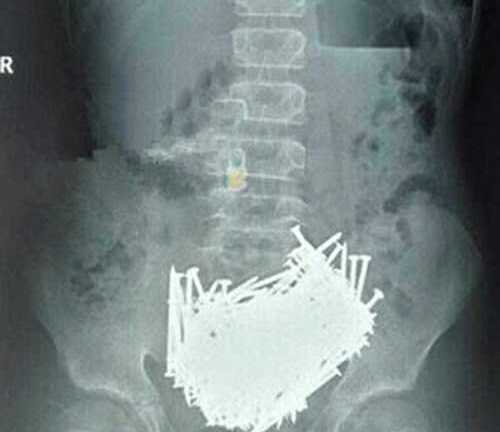 Mổ lấy hơn 200 cây đinh, tiền xu trong bụng cậu bé 15 tuổi