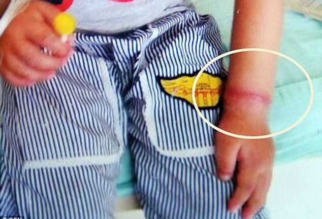 Dây chun 'ăn' dần vào thịt, cậu bé 4 tuổi suýt mất bàn tay