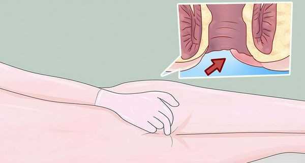 Ung thư hậu môn: Căn bệnh cực nguy hiểm thường bị bỏ qua