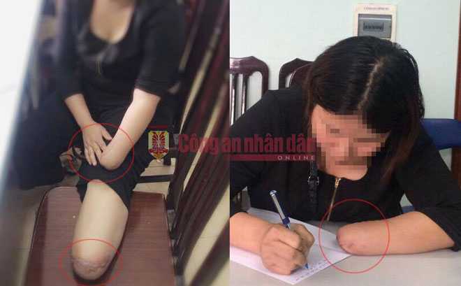 Tình tiết mới vụ thuê người chặt tay chân nhằm trục lợi 3,5 tỷ tiền bảo hiểm