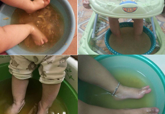 Tin tưởng bài thuốc dân gian truyền miệng, con trẻ gặp nguy hiểm