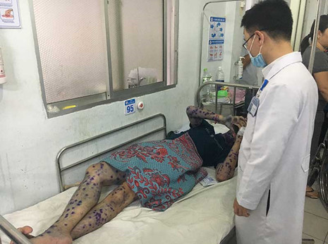 Gần 39.000 ca mắc thủy đậu 2017, vẫn tiếp tục tăng trong năm 2018