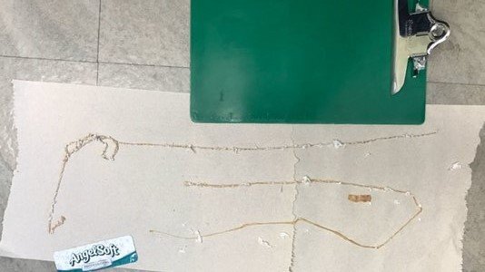 Thông tin mới về người đàn ông ăn sushi hàng ngày, mắc sán dây dài 1,67m