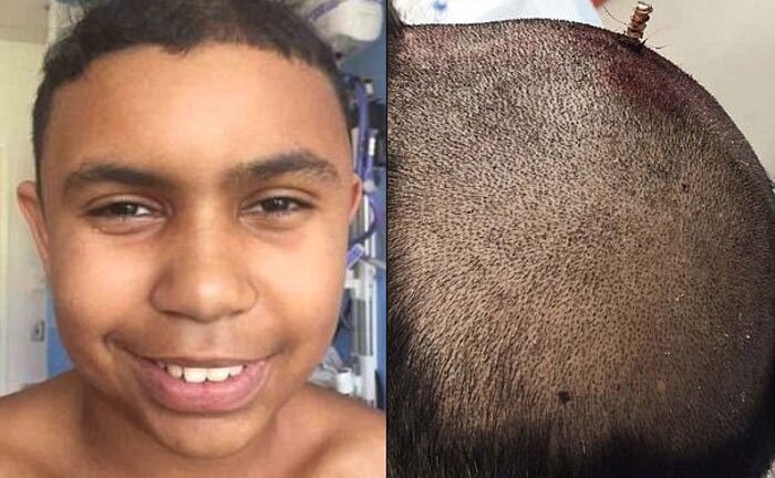 Cậu bé 13 tuổi bị chiếc đinh dài 15cm đâm xuyên sọ