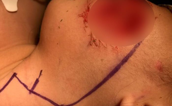 Bác sĩ BV Nhi đồng thốt lên 'kinh hoàng' vì quá nhiều bệnh nhi bị chó cắn