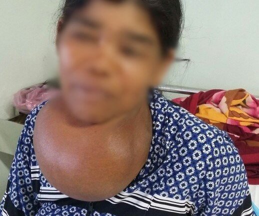 Khối u bướu giáp khổng lồ 35 năm trên cổ bệnh nhân