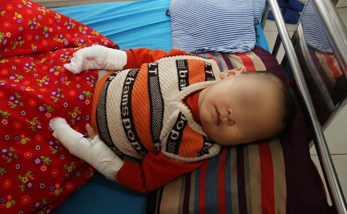 Cẩn thận bỏng nước sôi ở trẻ nhỏ trong mùa đông