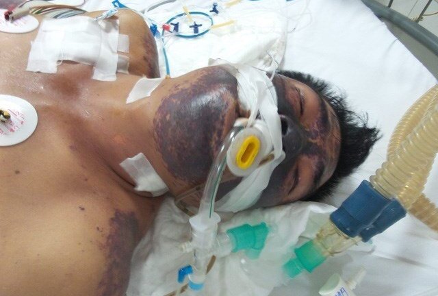 Hàng trăm người nhiễm liên cầu lợn, hàng chục 'tín đồ' tiết canh chết thảm