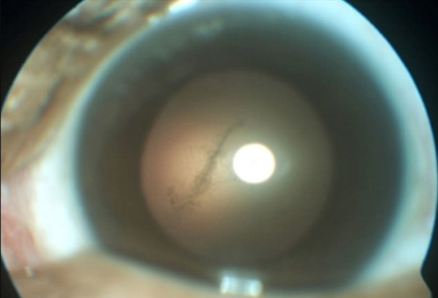 Suýt mù mắt, nhận quả đắng nhớ đời vì ăn thịt lợn chưa nấu chín