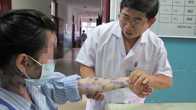 Vì sao bệnh thủy đậu lành tính nhưng có thể biến chứng chết người?