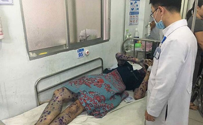 Bệnh thủy đậu là gì, phòng bệnh thủy đậu thế nào, mua thuốc trị thủy đậu ở đâu?