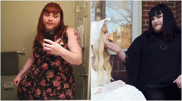 Chứng bệnh lạ khiến cô gái phải cạo râu hàng ngày suốt 14 năm