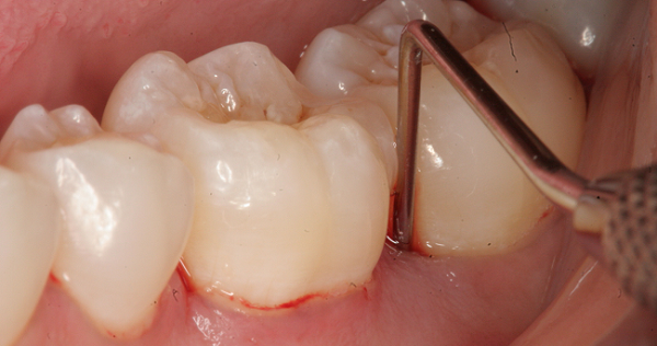 Nhổ răng số 8 có nguy hiểm không?