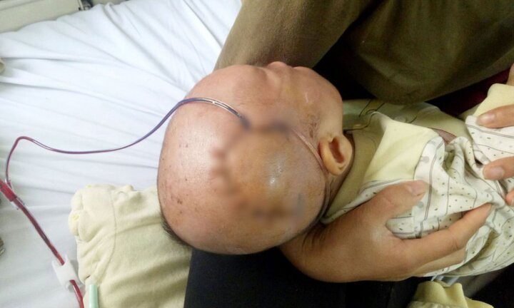 Ngã từ trên giuờng xuống, bé trai 9 tháng tuổi bị lún sọ não