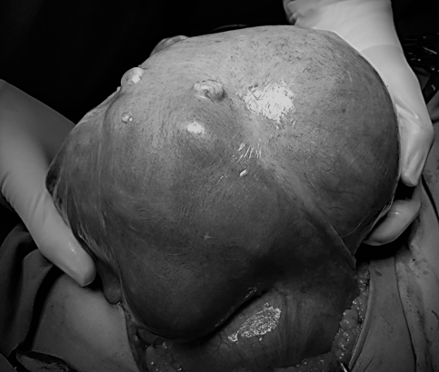 Không nên chủ quan với u xơ cổ tử cung vì lý do này