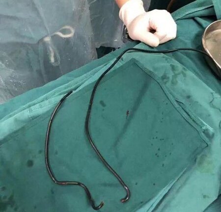 Dùng dây cáp dài gần 1m chọc vào ống niệu đạo để... gãi ngứa