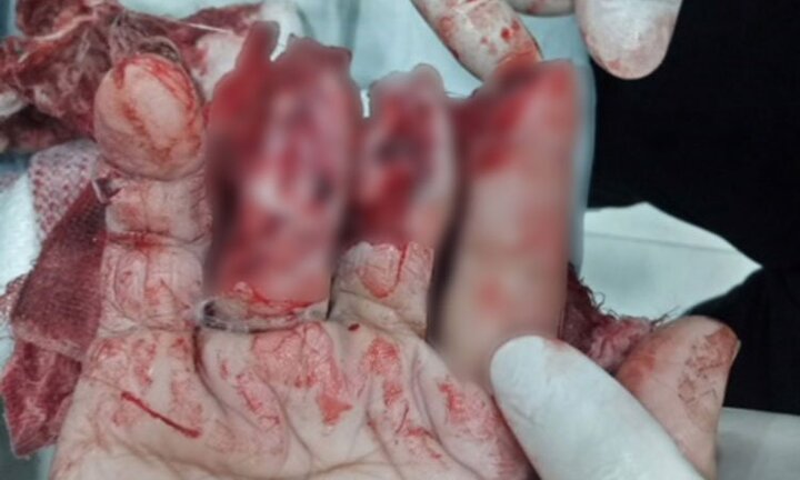 Đứt lìa ngón tay, không thể khâu nối vì sai lầm này