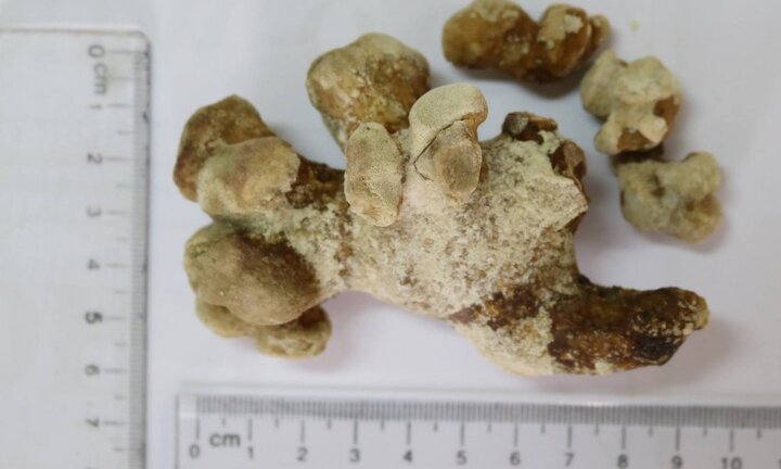 Cụ ông 71 tuổi mang khối sỏi san hô to ở hai bên thận