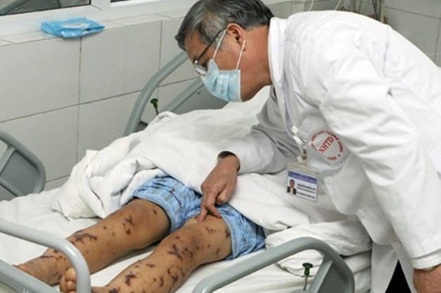 Viêm màng não do nhiễm khuẩn não mô cầu: Căn bệnh nguy hiểm chết người