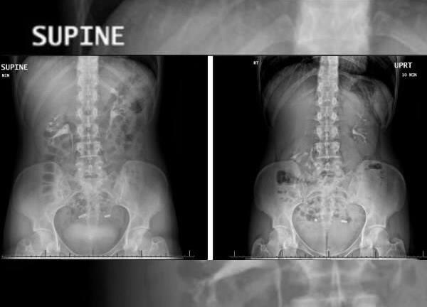 Người phụ nữ khổ sở vì quả thận ‘nổi’ rơi xuống xương chậu mỗi khi đứng lên