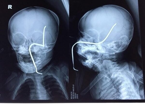 Tội nghiệp bé gái 8 tháng tuổi bị thanh sắt rỉ đâm thủng sọ